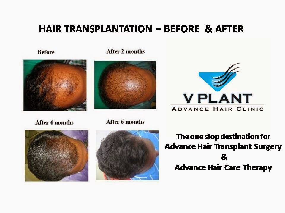 Hair Restoration Surgery Cost In Kochi Events Universe